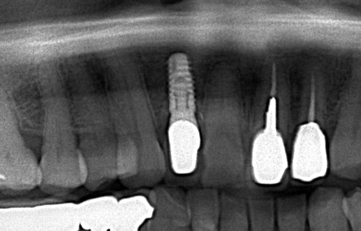 インプラントの例